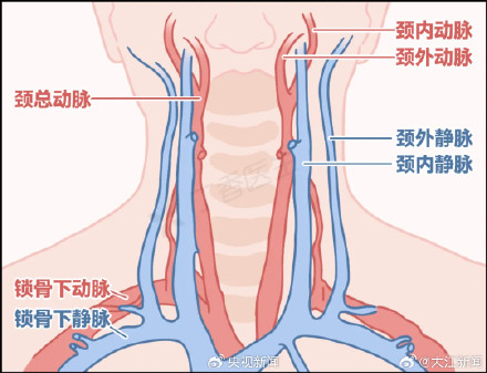 男子用筋膜枪按脖子引发脑梗