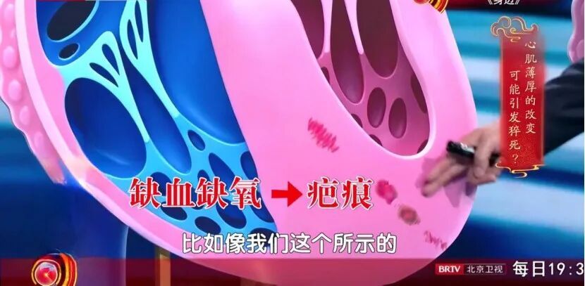 中老年猝死真相:不是心慌,是它悄悄“变形”了,高血压也是帮凶之一 中老年猝死真相:不是心慌,是它悄悄“变形”了,高血压也是帮凶之一