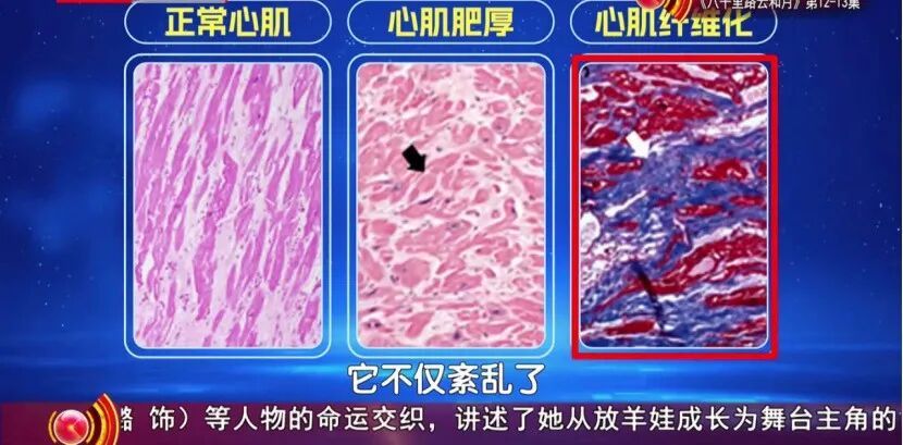 中老年猝死真相:不是心慌,是它悄悄“变形”了,高血压也是帮凶之一 中老年猝死真相:不是心慌,是它悄悄“变形”了,高血压也是帮凶之一