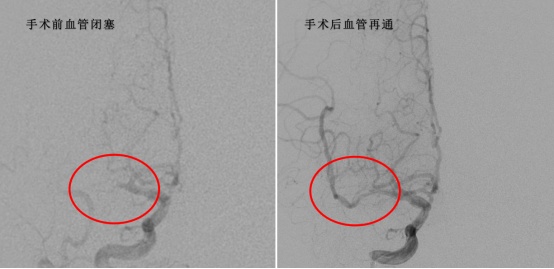 一斤白酒落肚!54岁男子第二天突发急性中风 医生提醒这类人群要注意 一斤白酒落肚!54岁男子第二天突发急性中风 医生提醒这类人群要注意