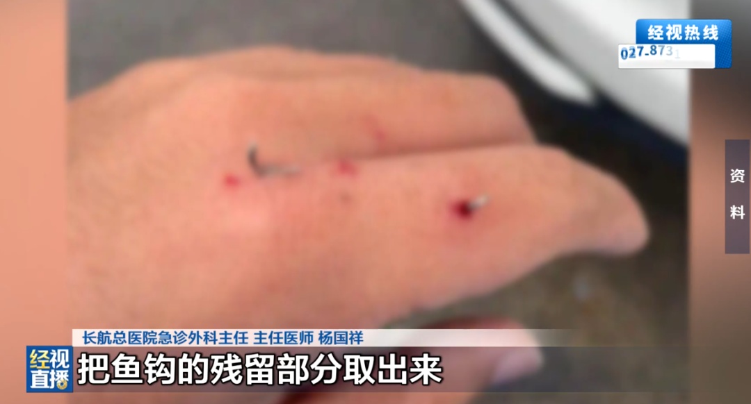武汉钓鱼男子被鱼钩刺穿手部,现场自行拉扯后剧痛,神经受损!医生紧急提醒 武汉钓鱼男子被鱼钩刺穿手部,现场自行拉扯后剧痛,神经受损!医生紧急提醒