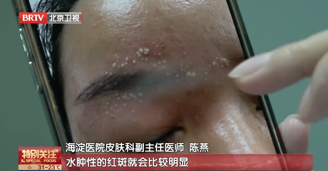 北京已有人中招，千万不能拍，毒液堪比硫酸，会毁容——