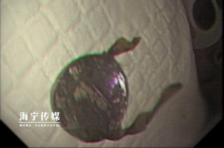 闯大祸!海宁4岁男孩边吃边玩,竟整个吞下一枚1元硬币…… 闯大祸!海宁4岁男孩边吃边玩,竟整个吞下一枚1元硬币……