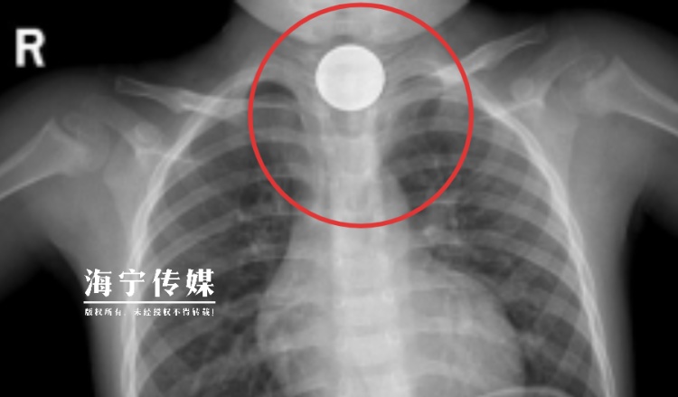 闯大祸!海宁4岁男孩边吃边玩,竟整个吞下一枚1元硬币…… 闯大祸!海宁4岁男孩边吃边玩,竟整个吞下一枚1元硬币……