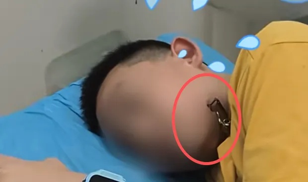 湖南12岁男孩湖边玩耍被垂钓者甩出的鱼钩“咬”脸!提醒:别上去凑热闹 湖南12岁男孩湖边玩耍被垂钓者甩出的鱼钩“咬”脸!提醒:别上去凑热闹