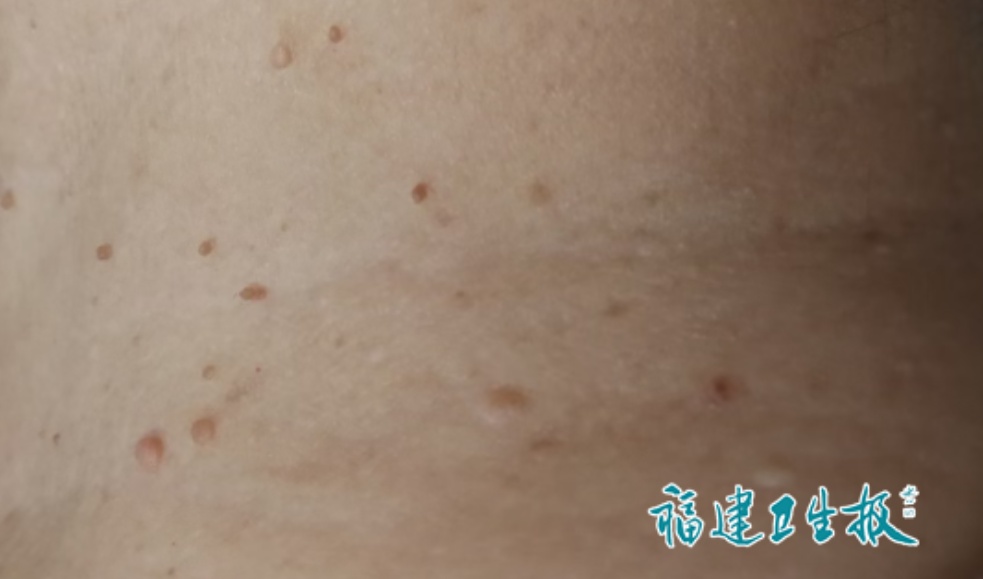密密麻麻，女子脖子上长满“小肉球”，医生：会传染，千万别挠