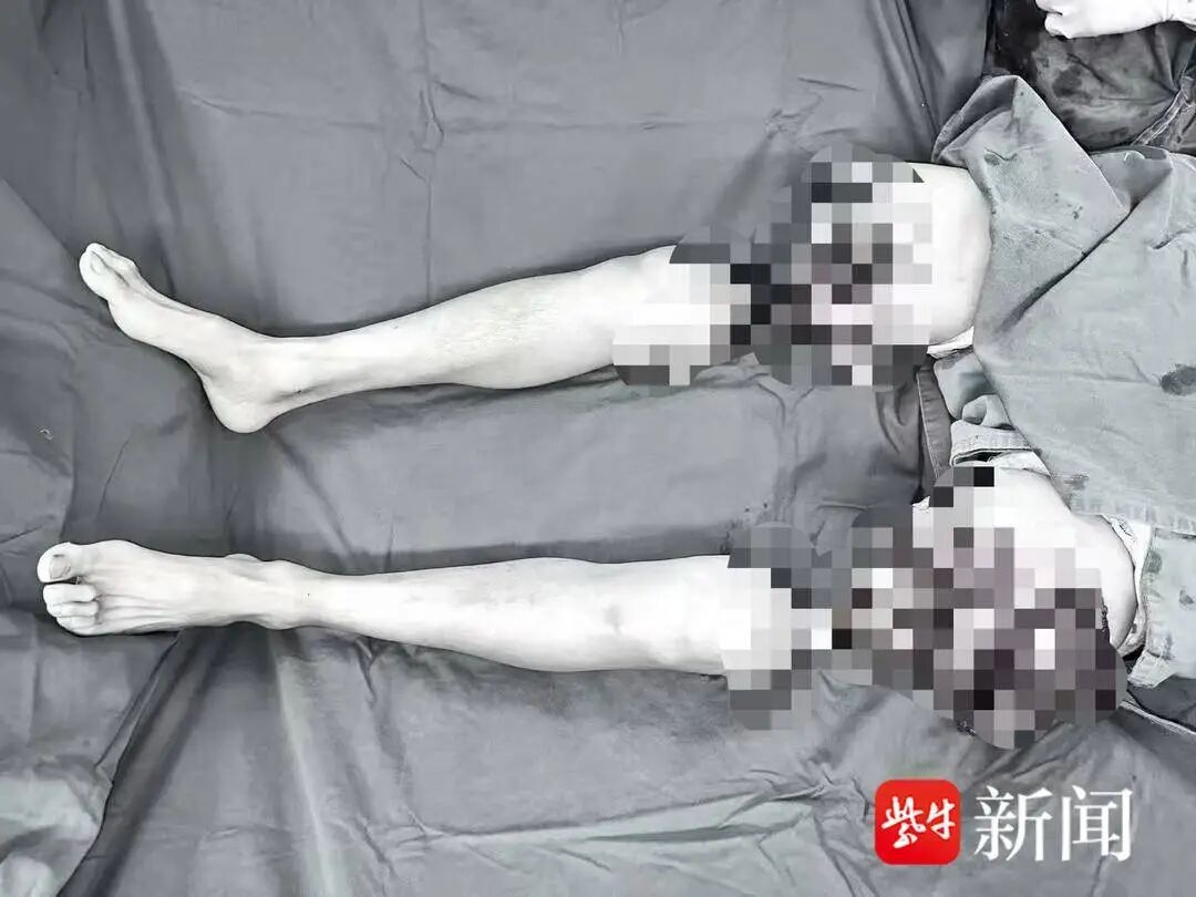 男子双大腿被绞断完全分离，经手术重新“接”回