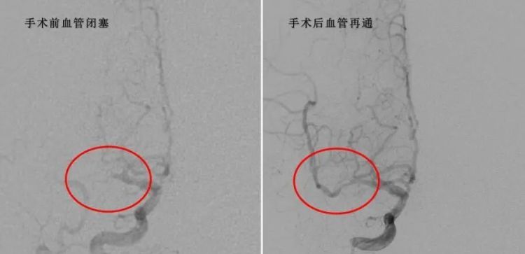 54岁男子常年久坐，爱吃肥肉，一斤白酒落肚后，第二天醒来突发急性脑梗，医生提醒