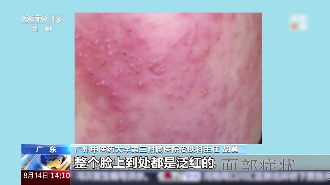 美白又淡斑,这款网红面霜真这么神奇?专家:当心引发“激素脸”! 美白又淡斑,这款网红面霜真这么神奇?专家:当心引发“激素脸”!