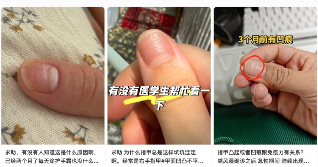 伸手看看!贫血的人,指甲可能有这3个信号 伸手看看!贫血的人,指甲可能有这3个信号