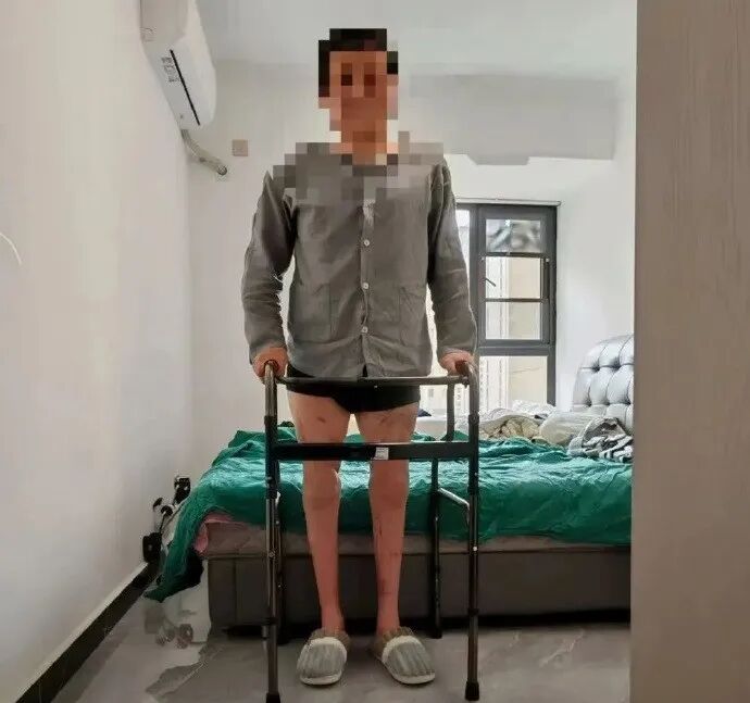 男子因意外双大腿被截断,完全分离体外近3小时,手术后被医生成功接回! 男子因意外双大腿被截断,完全分离体外近3小时,手术后被医生成功接回!