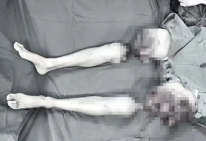 男子因意外双大腿被截断,完全分离体外近3小时,手术后被医生成功接回! 男子因意外双大腿被截断,完全分离体外近3小时,手术后被医生成功接回!