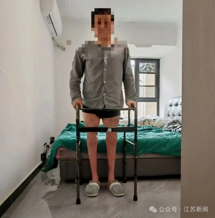 双大腿被压断,完全离体3小时,被中国医生接回去了! 双大腿被压断,完全离体3小时,被中国医生接回去了!