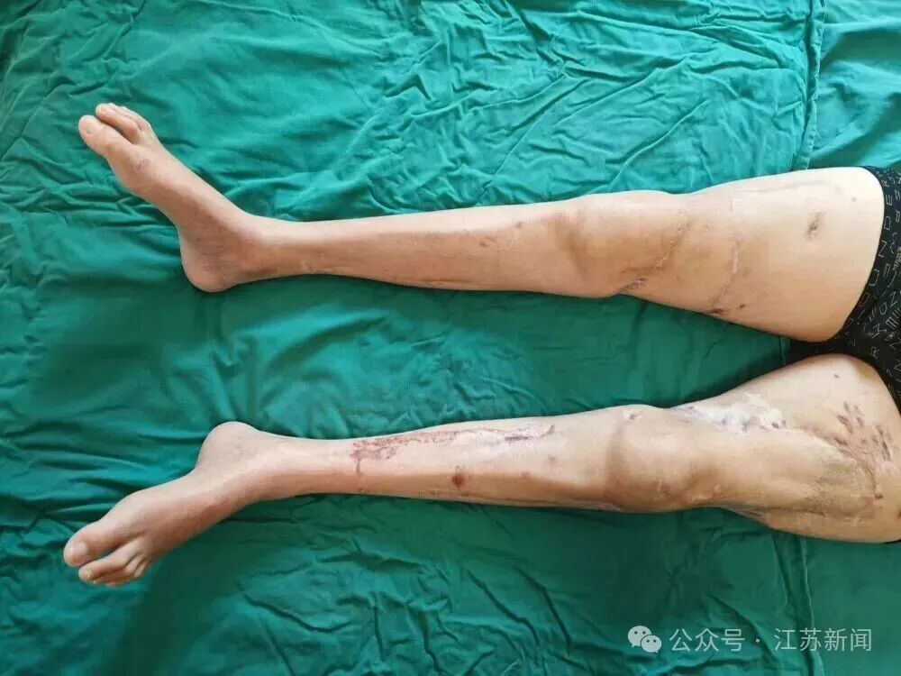 双大腿被压断,完全离体3小时,被中国医生接回去了! 双大腿被压断,完全离体3小时,被中国医生接回去了!