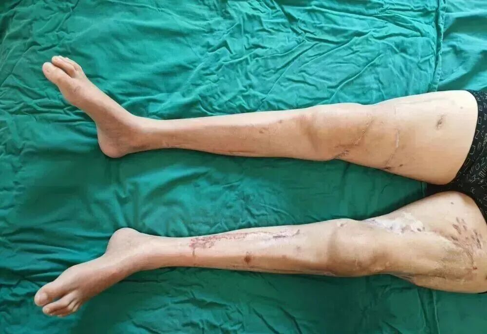 男子因意外双大腿被截断,完全分离体外近3小时,手术后被医生成功接回! 男子因意外双大腿被截断,完全分离体外近3小时,手术后被医生成功接回!