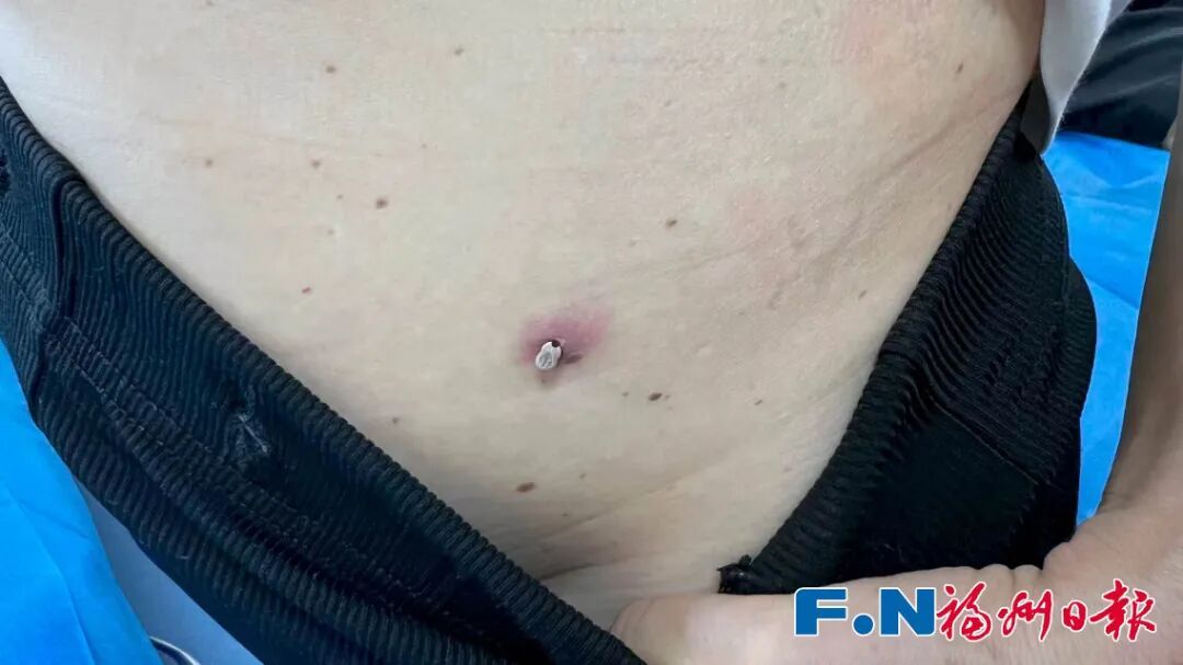 吓人！福州王女士国外回来，身上突然长了颗“黑痣”！医生：赶紧处理