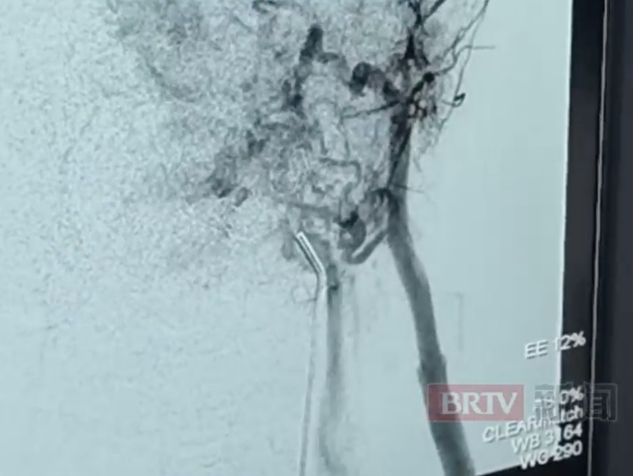 孩子换牙期拔牙险丧命!这种“脸红”不是可爱,医生提醒—— 孩子换牙期拔牙险丧命!这种“脸红”不是可爱,医生提醒——