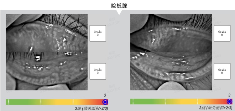 27岁的小伙,眼睛70岁!医生提醒:过度用眼+熬夜是主要诱因,日常可这样缓解 27岁的小伙,眼睛70岁!医生提醒:过度用眼+熬夜是主要诱因,日常可这样缓解