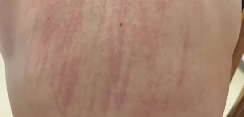 一觉醒来浑身遍布“鞭痕”,不痛不痒却吓坏大爷!元凶竟是…… 一觉醒来浑身遍布“鞭痕”,不痛不痒却吓坏大爷!元凶竟是……