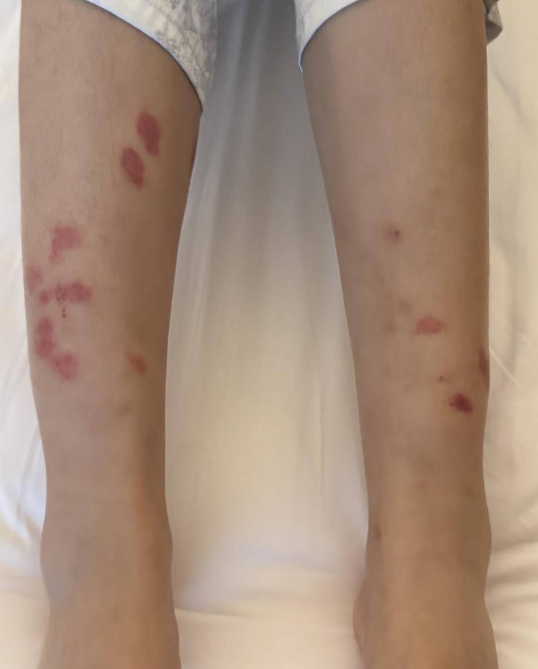 花2000多入住深圳一酒店后女子腿上出现大片红疹,医院诊断为虫咬皮炎 花2000多入住深圳一酒店后女子腿上出现大片红疹,医院诊断为虫咬皮炎