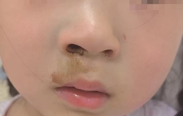 进入人体2小时就会造成不可逆的损伤！昆明一幼童误将这个小东西塞进鼻腔……