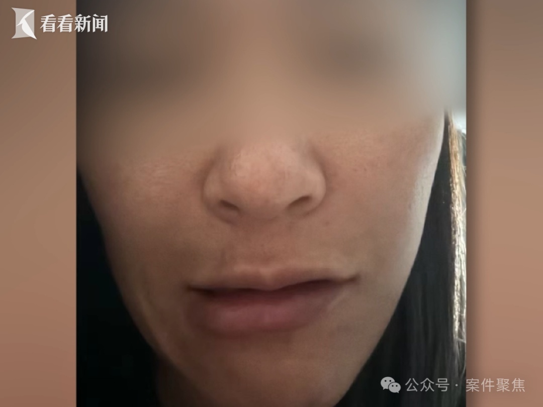 4名女子贪便宜频繁打三无美容针,致1死2伤;检方:以非法行医罪对打针者提起公诉 4名女子贪便宜频繁打三无美容针,致1死2伤;检方:以非法行医罪对打针者提起公诉