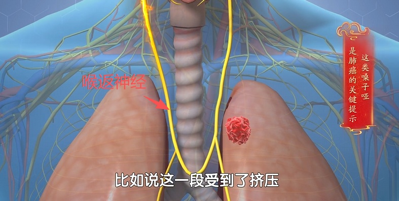 体内有癌,嗓子先知?出现这几个信号别当感冒拖上海瑞金医院:癌细胞或已存在 体内有癌,嗓子先知?出现这几个信号别当感冒拖上海瑞金医院:癌细胞或已存在
