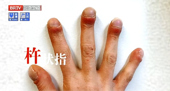 体内有癌,嗓子先知?出现这几个信号别当感冒拖上海瑞金医院:癌细胞或已存在 体内有癌,嗓子先知?出现这几个信号别当感冒拖上海瑞金医院:癌细胞或已存在