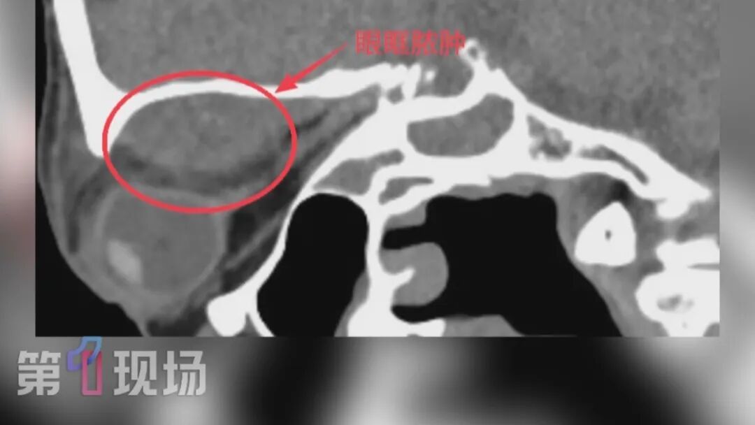 70岁老人险些失明!医生:和鼻子有关 70岁老人险些失明!医生:和鼻子有关