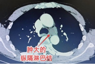 体内有癌,嗓子先知?出现这几个信号别当感冒拖上海瑞金医院:癌细胞或已存在 体内有癌,嗓子先知?出现这几个信号别当感冒拖上海瑞金医院:癌细胞或已存在