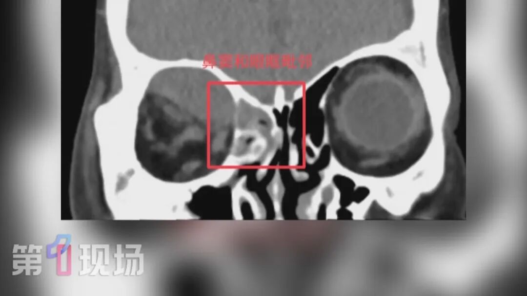 70岁老人险些失明!医生:和鼻子有关 70岁老人险些失明!医生:和鼻子有关