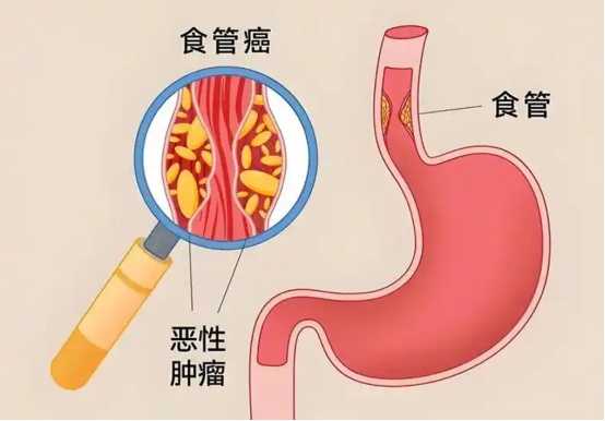 这类食物被列为2A类致癌物,许多人不经意天天吃 这类食物被列为2A类致癌物,许多人不经意天天吃