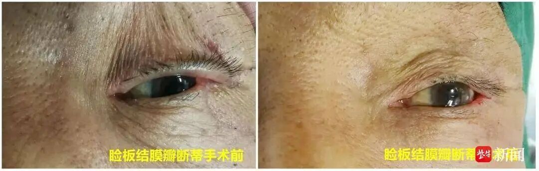 眼皮上黄豆大肉疙瘩越长越大，实则是恶性肿瘤，已侵害眼睑结构和功能