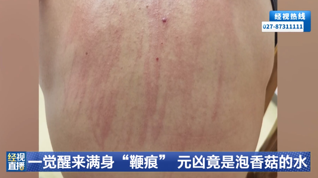 一觉醒来，男子身上遍布“鞭痕”，原因竟是一碗水；这些食物“焯一下”远远不够