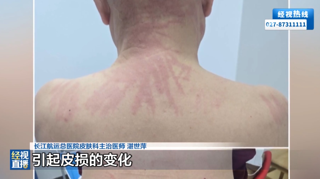 一觉醒来，男子身上遍布“鞭痕”，原因竟是一碗水；这些食物“焯一下”远远不够