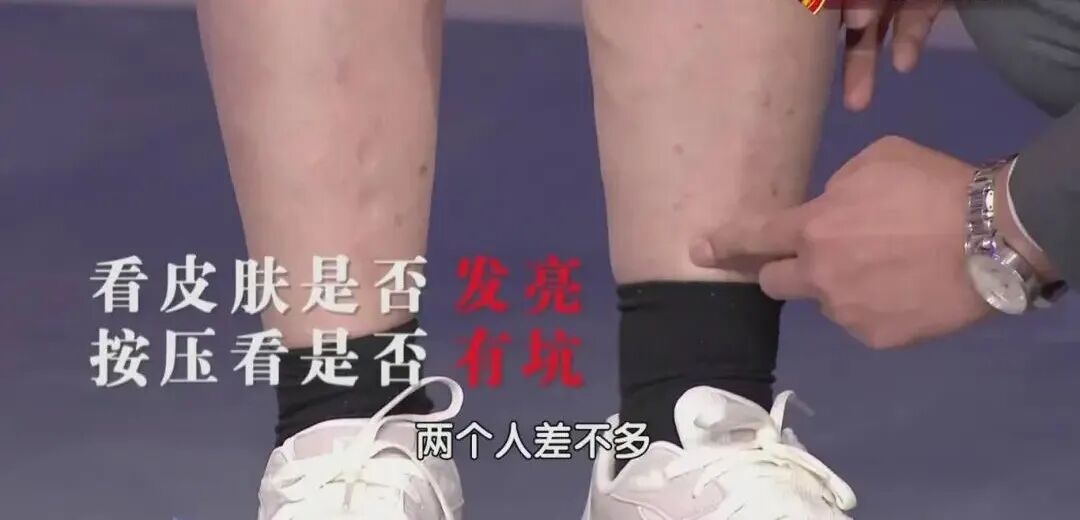比胆固醇更危险?这个血脂指标偏高,心衰风险暴增77%,很多人都漏掉了 比胆固醇更危险?这个血脂指标偏高,心衰风险暴增77%,很多人都漏掉了