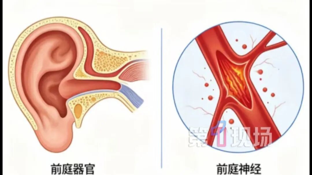 深圳38岁程序员熬夜加班后，眩晕呕吐不止，一查竟是耳朵“短路”