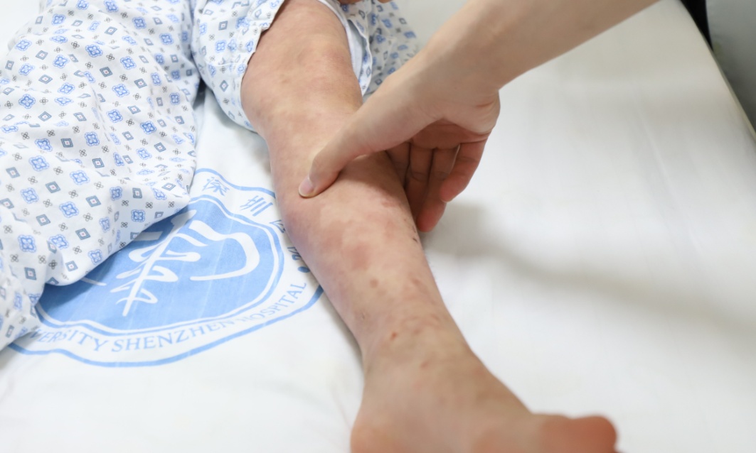 深圳7岁女童,全身80%皮肤糜烂、渗液!竟是因熟人推荐的“止痒秘方”… 深圳7岁女童,全身80%皮肤糜烂、渗液!竟是因熟人推荐的“止痒秘方”…