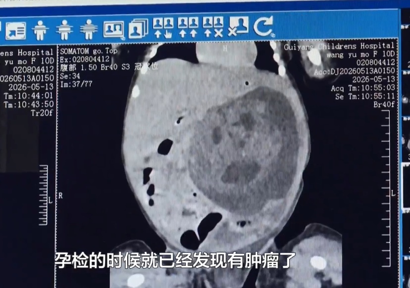 胎儿还没出生就查出肿瘤!贵州医护多学科接力,超低龄宝宝闯关成功顺利出院 胎儿还没出生就查出肿瘤!贵州医护多学科接力,超低龄宝宝闯关成功顺利出院