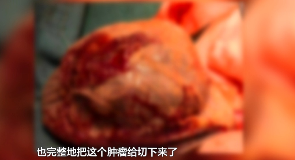 胎儿还没出生就查出肿瘤!贵州医护多学科接力,超低龄宝宝闯关成功顺利出院 胎儿还没出生就查出肿瘤!贵州医护多学科接力,超低龄宝宝闯关成功顺利出院