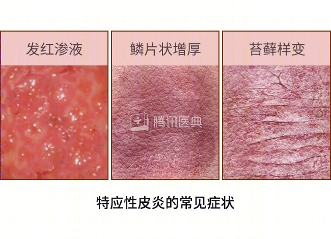深圳7岁女童,全身80%皮肤糜烂、渗液!竟是因熟人推荐的“止痒秘方”… 深圳7岁女童,全身80%皮肤糜烂、渗液!竟是因熟人推荐的“止痒秘方”…