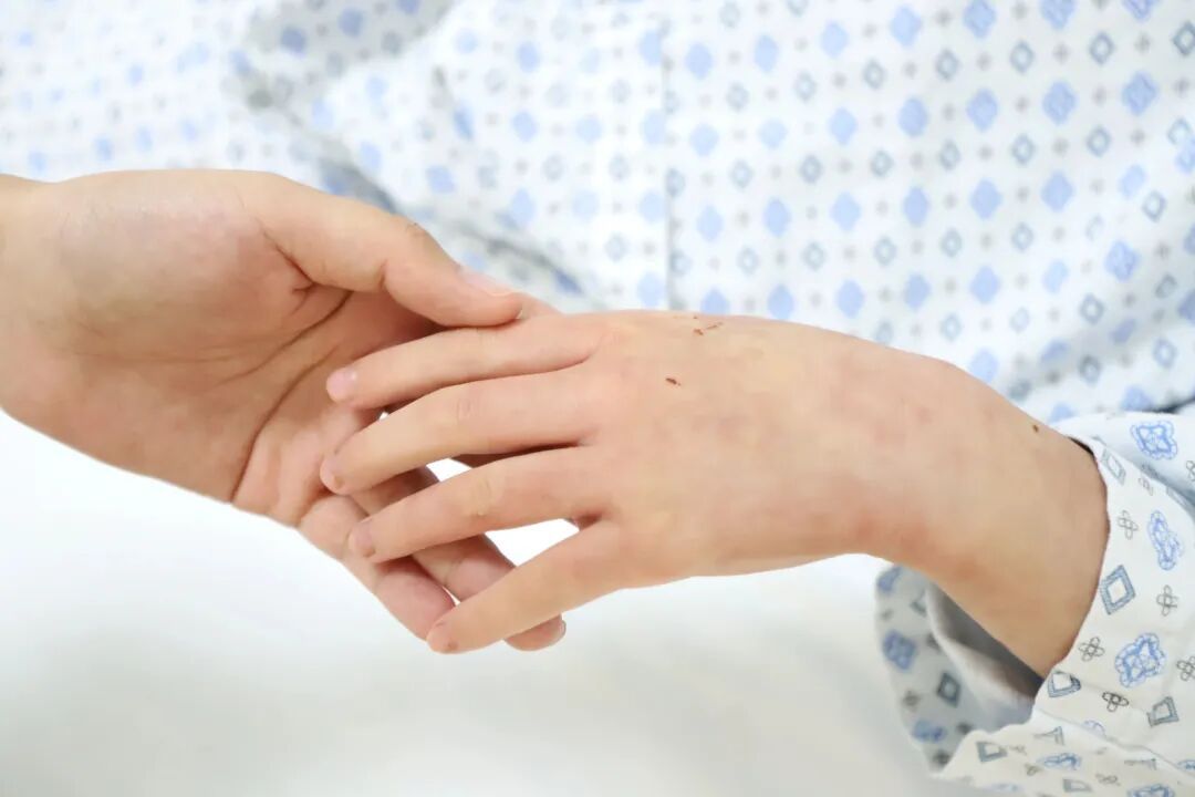 深圳7岁女童,全身80%皮肤糜烂、渗液!竟是因熟人推荐的“止痒秘方”… 深圳7岁女童,全身80%皮肤糜烂、渗液!竟是因熟人推荐的“止痒秘方”…