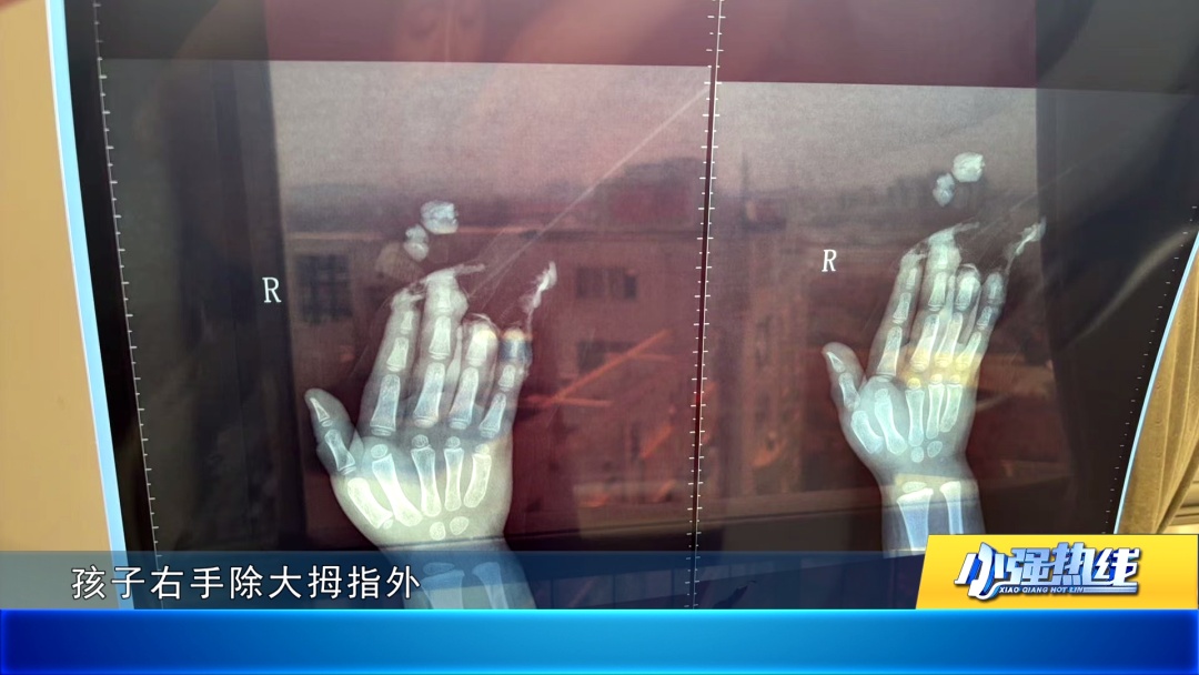 揪心！佛山2岁女童被“咬伤”四指，或致终身残疾！家长直指“凶手”是商场的摇摇车