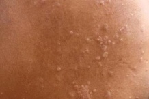 女子用公用瑜伽垫后感染HPV!医生:这些“高危物品”千万别共用 女子用公用瑜伽垫后感染HPV!医生:这些“高危物品”千万别共用