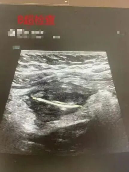吃饭时一个动作，女子肠子被刺破，肚子有大片阴影！本人悔惨：再也不敢了......