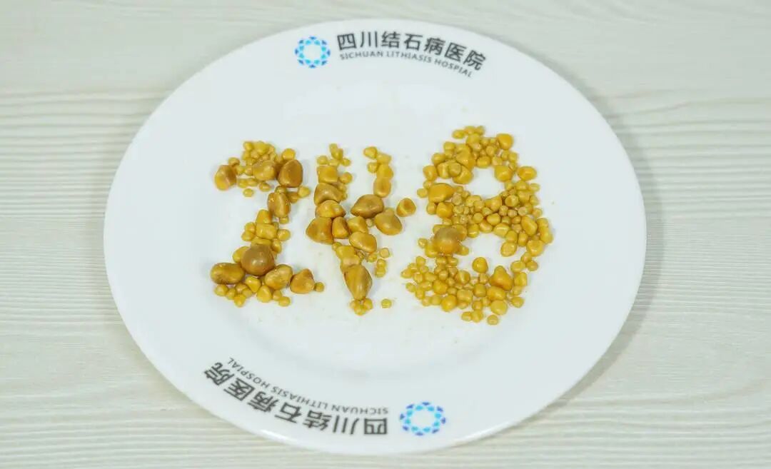 三餐靠外卖，偏爱冒菜炸鸡烧烤，26岁小伙胆囊内取出248颗结石，铺满一大盘，医生提醒