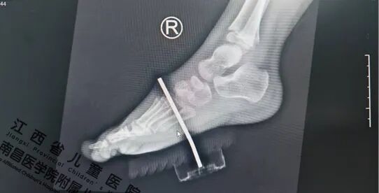 男孩玩TA手指被贯穿!你家可能也有同款玩具️ 男孩玩TA手指被贯穿!你家可能也有同款玩具️