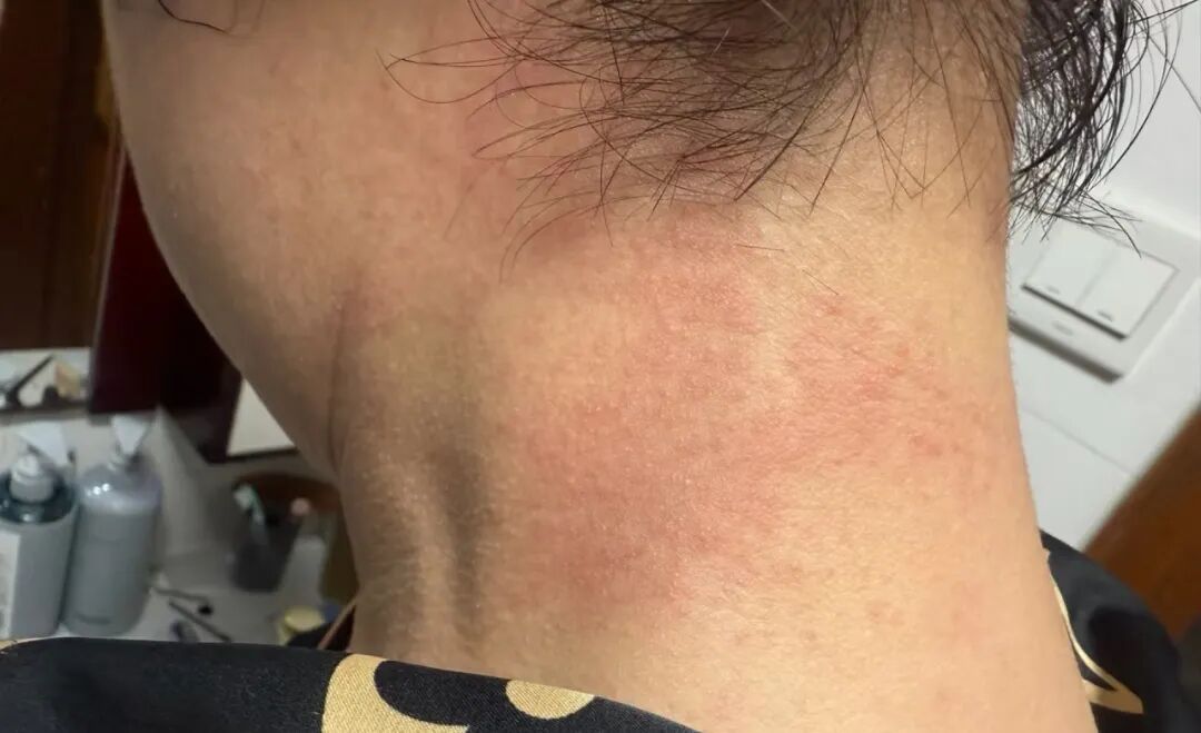 身上经常痒,病根可能在内脏,第1种就是癌,别只当蚊子包、皮肤病 身上经常痒,病根可能在内脏,第1种就是癌,别只当蚊子包、皮肤病