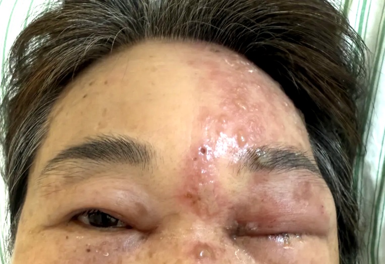 别以为“缠腰龙”只长在腰上!长在这个位置,风险极高,或致失明 别以为“缠腰龙”只长在腰上!长在这个位置,风险极高,或致失明