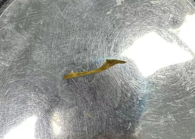 吃鱼被刺儿扎,究竟能有多大危害?黑龙江两例紧急救治警醒每一个“鱼刺中招者”! 吃鱼被刺儿扎,究竟能有多大危害?黑龙江两例紧急救治警醒每一个“鱼刺中招者”!